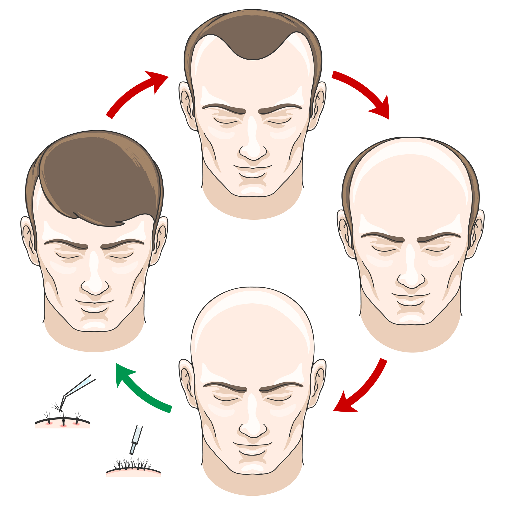 Stages of hair loss, treatment and transplantation