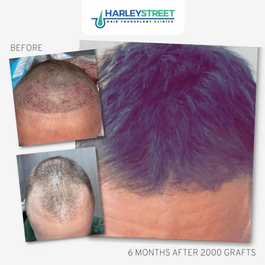 Hair Transplant Before and After Results 10 FUE-Before-and-After-9