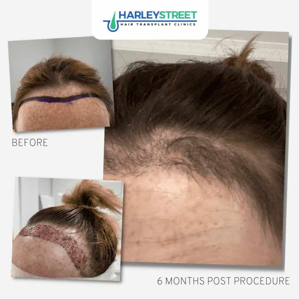 Hair Transplant Before and After Results 15 FUE-Female-Hair-Transplant-Before-and-After