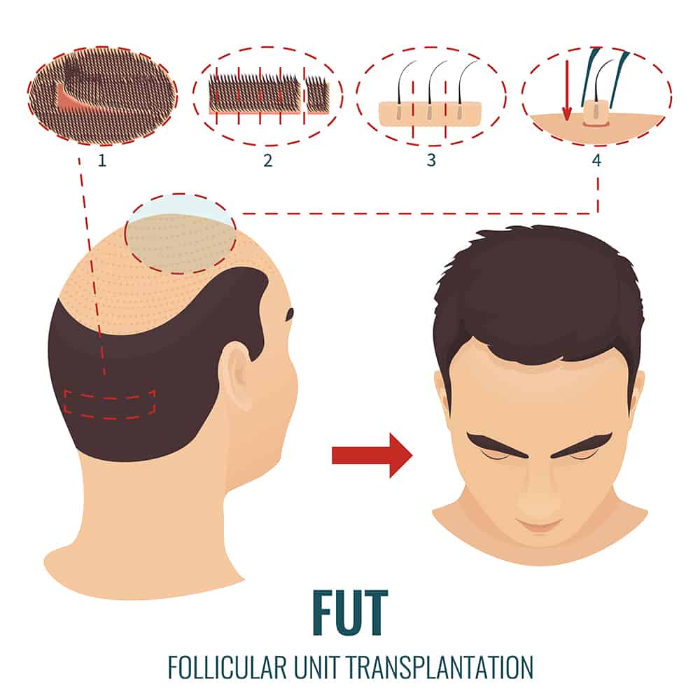 FUT stages treatment