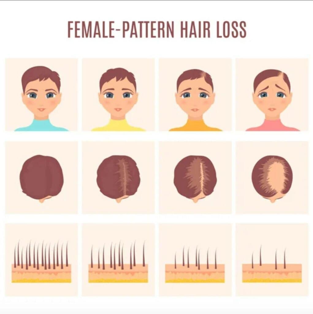 female-pattern-hair-loss